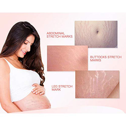 AICHUN BEAUTY Pregnancy Cream Stretch Mark Remover Scars Repair Cellulites Lotion Cream 150ml