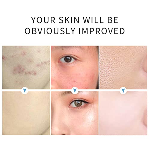AICHUN BEAUTY Face Serum 2% Salicylic Acid Exfoliation Anti-Acne Facial Smooth Essence 30ml/1.01Fl Oz