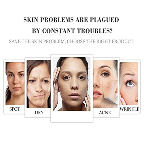 AICHUN BEAUTY Freckle Cream 3 Days Deep Moisturizing Fleck Removing Concentration Cleansing Soothing Face Skin 30ml/1fl.oz