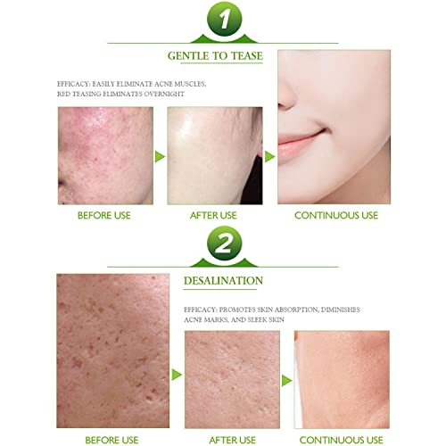 AICHUN BEAUTY Face Acne Cleaning Cream Skin Care Remove Repair Comedone Pimple Acne Face Acne Cream