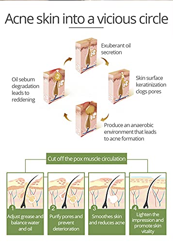 AICHUN BEAUTY Anti-Acne Facial Serum Aloe Vera Extract Salicylic Acid Repairs Damaged Skin 30ml