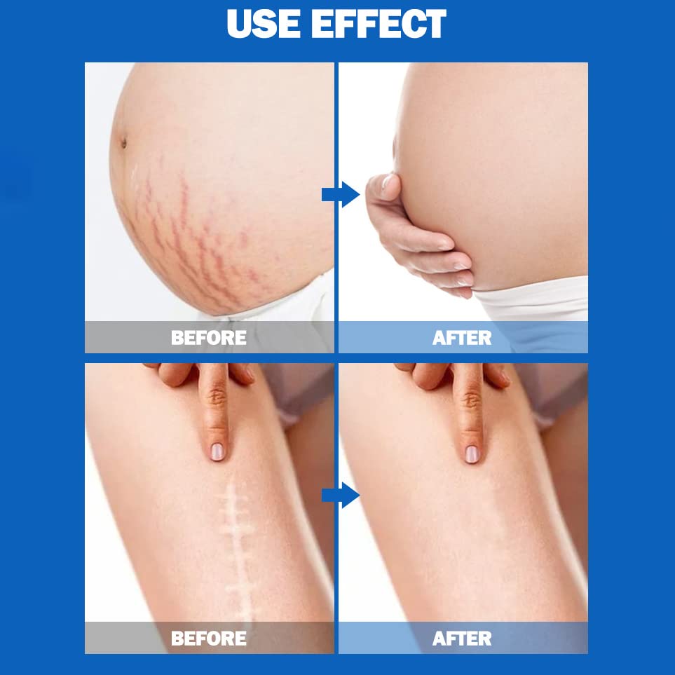 AICHUN BEAUTY Anti-Stretch Mark Essential Oil Capsules Prevents Removes Stretch Marks Scars Cellulitis 400mgx90pcs