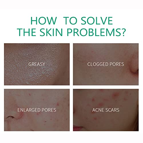AICHUN BEAUTY Anti-Acne Cream Treats Pimple Clogged Pores Oil Control Reduces Acne Scars Shrinks Pores 20g / 0.68fl.oz